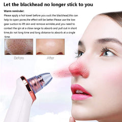 Advanced Pore Cleanser Vacuum – Blackhead Removal and Skin Exfoliation Tool